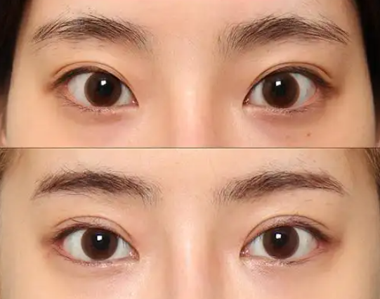 开眼角手术疼不疼？