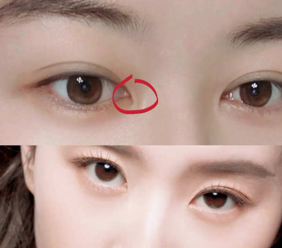 开眼角手术前需要做哪些准备？