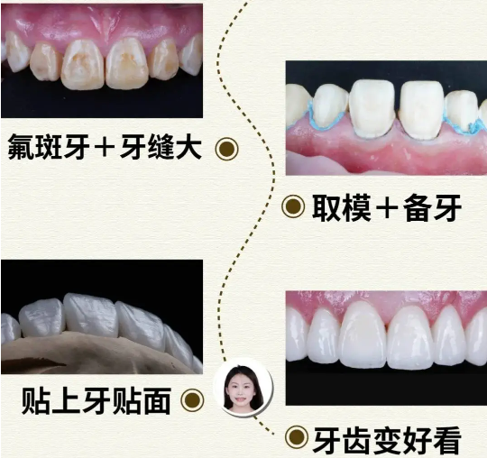 全口氟保护漆是否对牙齿有副作用？