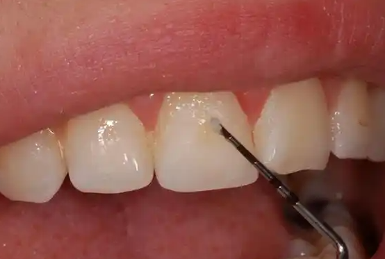 全口氟保护漆是否对牙齿有副作用？